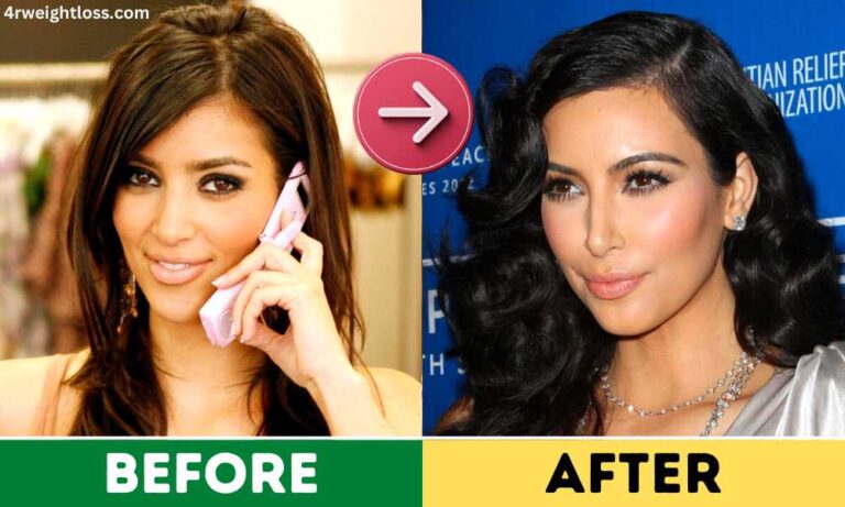 Kim Kardashian Plastic Surgery Before and After Pictures