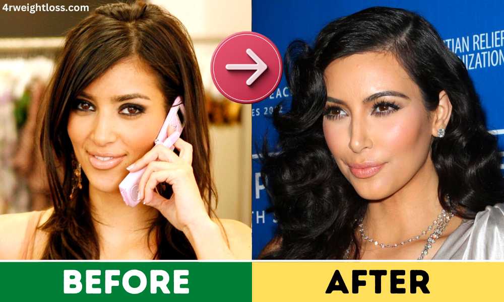 Kim Kardashian Plastic Surgery 2024 (Before & After Photos)